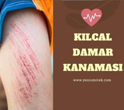 Kılcal Damar Kanaması Nasıl Olur? Kılcal Damar Kanaması Nasıl Olur?